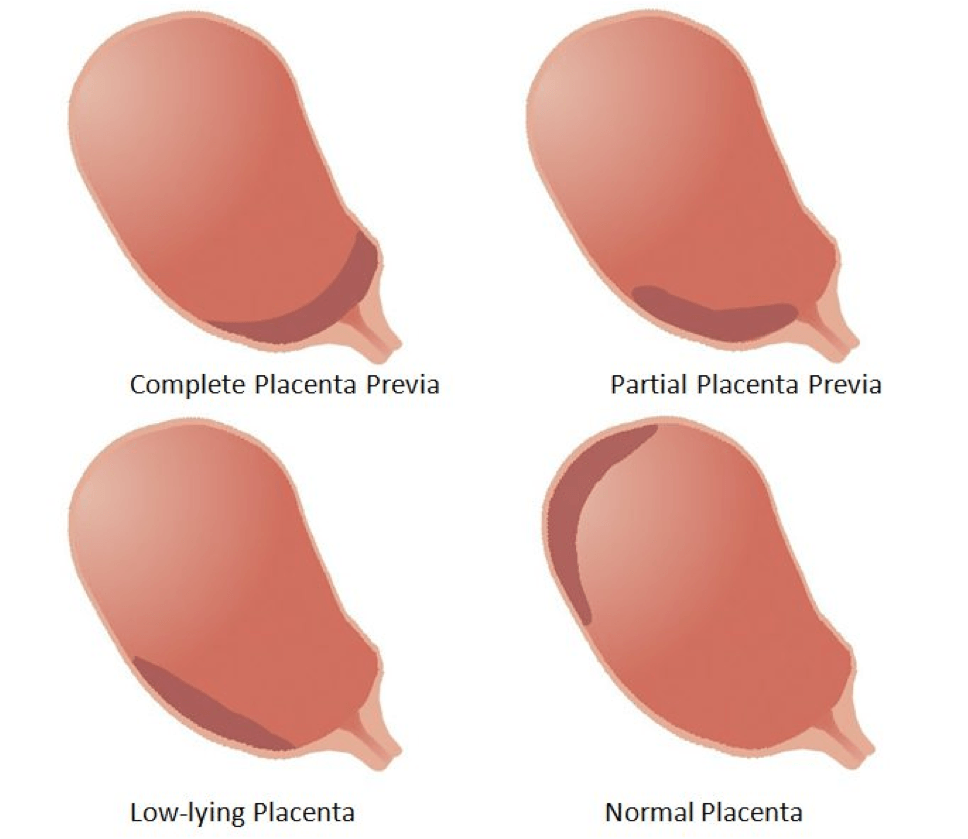 placenta previa types