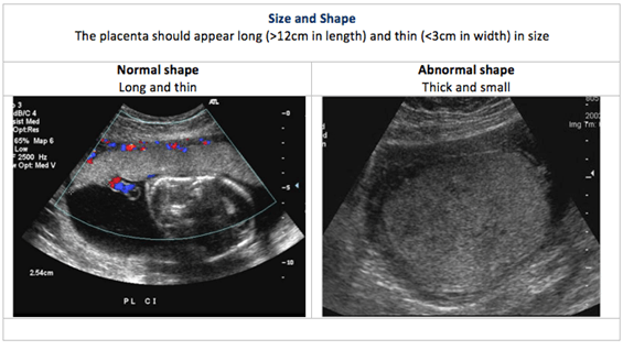Placental ultrasound size and shape