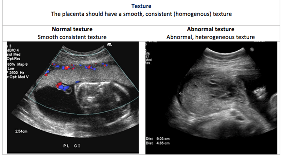 Placental ultrasound texture
