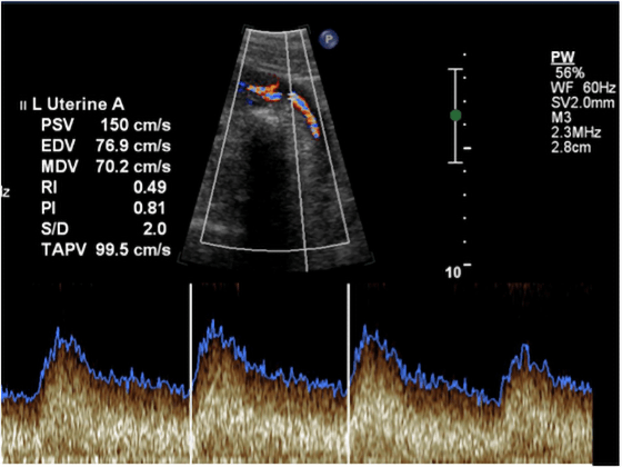 Umbilical artery Doppler