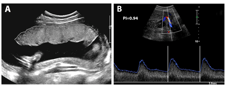 image of placenta ultrasound