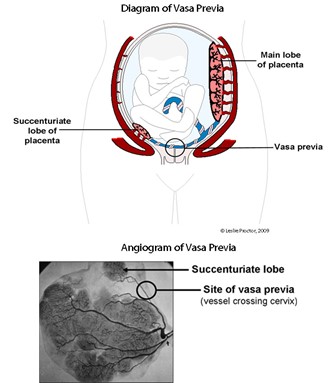 vasa previa diagram